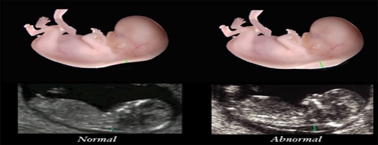 <p>Fetal Nuchal Translucency</p>