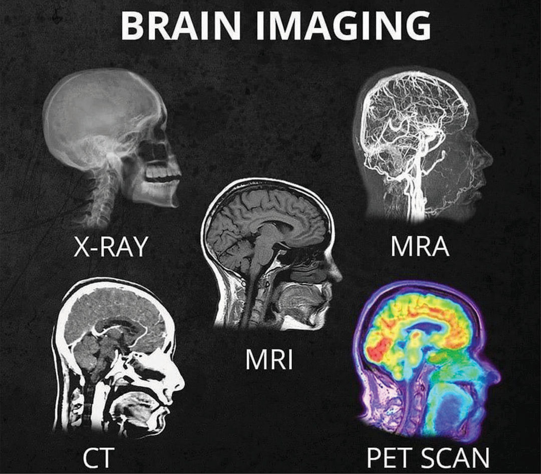 <p><strong>CT:</strong> Structural abnormalities like fractures or tumors.</p><p><strong>MRI:</strong> Detailed soft tissue contrast for conditions like MS.</p><p><strong>PET:</strong> Functional/metabolic insights, e.g., glucose metabolism in tumors.</p>