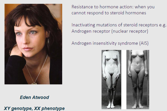 <p>✿Resistance to hormone action refers to the inability of cells to respond to the effects of steroid hormones despite normal hormone levels.</p><p>✿This resistance can occur due to inactivating mutations in steroid receptors, which prevent the receptors from properly binding to their hormone ligands and initiating the downstream signalling cascade.</p><p>✿One example of a disorder resulting from inactivating mutations of a steroid receptor is Androgen Insensitivity Syndrome (AIS), which is caused by mutations in the androgen receptor gene.</p><p>✿In AIS, individuals with XY chromosomes have impaired responsiveness to androgens, leading to incomplete masculinization of external genitalia and, in severe cases, development of female secondary sexual characteristics.</p>