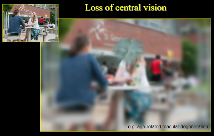 <p><strong>Loss of central vision:</strong> Occurs when the macula or fovea is damaged, resulting in loss of detailed vision.</p><p><strong>Age-related macular degeneration (AMD):</strong> A common condition causing degeneration of the macula, leading to a loss of central vision.</p>