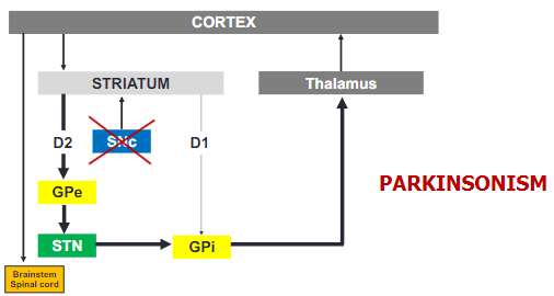 <p>In Parkinsonism, the loss of dopamine causes a shift in basal ganglia activity, leading to overactivity in the GPi.</p><p>This increased activity in the GPi results in greater inhibition of the thalamus, impairing motor function.</p>