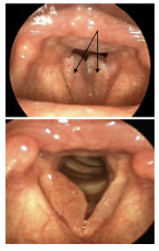 <p>Reinke’s Edema (also known as polypoid degeneration) :◦the build-up of fluid that occurs primarily in the superficial layer of the vocal folds –the outer most layer includes Reinke’sspace (in the lamina propria)◦Etiology: Edema is the result of trauma and misuse◦Secondary to excessive use of the vocal folds or as a result of infection or inflammation◦Chronic Reinke’sedema is most often associated with smoking and is seen more frequently in females.</p>