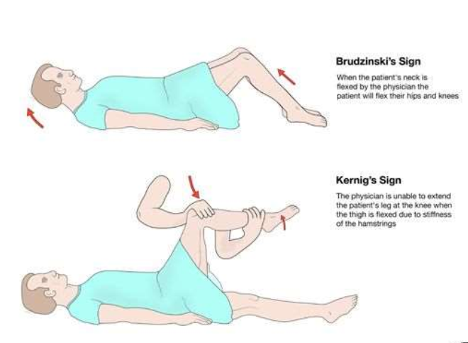 <p>Kernig - resistance to leg extension when lying.</p><p>Brudzinski - neck flexion causes flexion of hip and knee.</p>