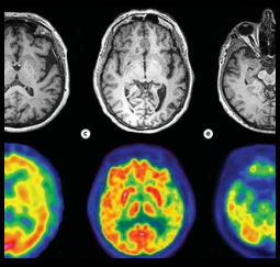 <p><strong>Anterior temporal regions</strong>: Damage occurs in the anterior regions of the temporal lobes, important for word meaning.</p>