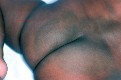 Common variation of hyperpigmentation in African-American, Asian, and Latino newborns. Blue-black-to-purple macular area at the sacrum or buttocks but sometimes on the abdomen, thigh, shoulders, or arms. Caused by deep dermal melanocytes and gradually fades during the first year. 

