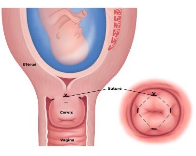 <p>Cerclage</p>