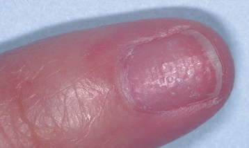 Sharply defined pitting and crumbling of nails with distal detachment often occurs with psoriasis

