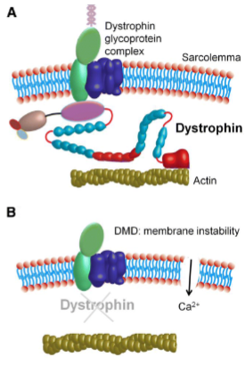 <p><strong>Duchenne muscular dystrophy (DMD)</strong>: Characterized by <strong>total loss of dystrophin</strong>.</p><p><strong>Becker muscular dystrophy (BMD)</strong>: Involves a <strong>reduced or dysfunctional dystrophin</strong>. Dystrophin links the internal cytoskeleton of the muscle cell to the extracellular matrix, which helps protect muscle fibers from damage during contraction and relaxation.</p>