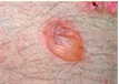 Larger than 1 cm diameter; usually single chambered
(unilocular); superficial in epidermis; thin-walled and
ruptures easily. Examples: friction blister, pemphigus,
burns, contact dermatitis

