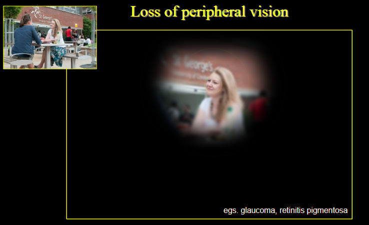 <p><strong>Loss of peripheral vision:</strong> Results from conditions such as <strong>glaucoma</strong> or <strong>retinitis pigmentosa</strong>.</p><p><strong>Glaucoma:</strong> Damages the optic nerve, leading to gradual peripheral vision loss.</p><p><strong>Retinitis pigmentosa:</strong> Degenerates photoreceptors in the peripheral retina, causing night blindness and loss of peripheral vision.</p>