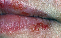 Infection has a prodrome
of skin tingling and sensitivity. Lesion then erupts with
tight vesicles followed by pustules and produces acute
gingivostomatitis with many shallow, painful ulcers.
Common location is upper lip; also in oral mucosa and
tongue.
