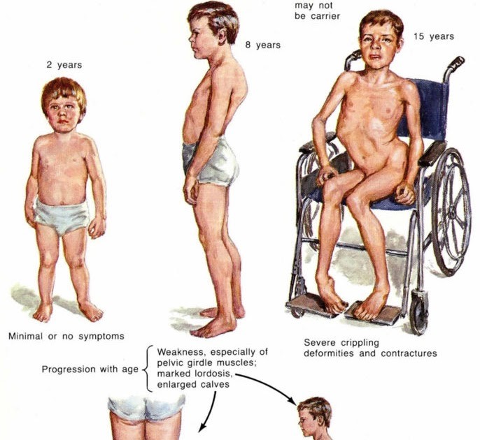 <p>Duchaunee </p><p>inherited genetic disorder</p><p>progress muscle weakness and wasting</p><p>no cure, steroids may slow</p><p>Hall mark sign: <span class="tt-bg-yellow">Gowers sign- difficult to stand up from floor</span></p>