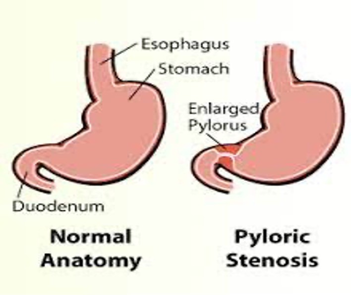 <p>&nbsp;thickening of pyloric muscle; <strong><em><u><span class="tt-bg-red">projectile vomiting</span></u></em></strong>; 3-6 weeks of life; males &gt; females;<strong><em><u><span class="tt-bg-red">&nbsp;**palpable ‘olive’ sized mass</span></u></em> RUQ**; </strong>pylorectomy(surgery)</p>