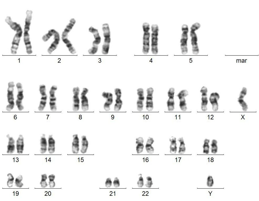 <p>•G-banding is a <span class="tt-bg-green">chromosome banding technique</span> that<span class="tt-bg-green"> involves partially digesting chromosomes</span> and staining them with the chemical stain <u><span class="tt-bg-green">Giemsa</span></u><span class="tt-bg-green">.</span></p><p></p><p>•The resulting banding pattern reveals <span class="tt-bg-yellow">alternating dark and light bands</span> along the chromosomes.</p><p></p><p>•The interpretation of G-banding patterns provides information about the <span class="tt-bg-blue">distribution of </span><strong><span class="tt-bg-blue">gene-rich </span></strong><span class="tt-bg-blue">and </span><strong><span class="tt-bg-blue">gene-poor</span></strong><span class="tt-bg-blue"> regions on chromosomes.</span></p>