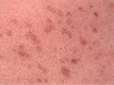 Solely a color change, flat and circumscribed, of less than 1 cm. Examples: freckles, flat nevi,
hypopigmentation, petechiae, measles, scarlet fever.
