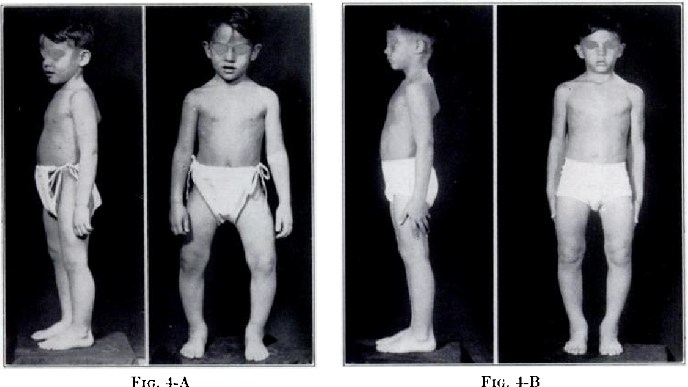 <p>♥︎A group of rare disease characterized by lack of reaction to vitamin D administered in doses sufficient to manage patients with rickets caused by vitamin D deficiency</p>
