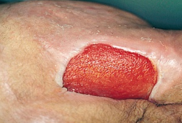 Wound extends into subcutaneous tissue and resembles a crater. See fat, granulation, and rolled edges. Do not see muscle, bone or tendon. 
