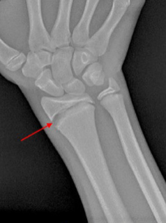 <p>The <strong>physeal</strong> (growth plate) is the <strong>weakest point</strong> of the bone, especially during <strong>growth spurts</strong>.</p><p>Physeal fractures have <strong>rapid healing</strong> due to the active growth of the growth plate.</p><p>However, there is a <strong>risk of growth arrest</strong> if the fracture is not properly treated.</p><p>Growth arrest can result in <strong>shortened bone</strong> or <strong>deformities</strong>.</p>