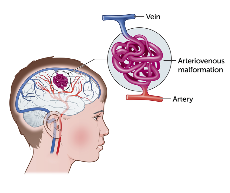 <p>Irregular. connected and poorly formed blood vessels; can cause bleeding, seizures</p>