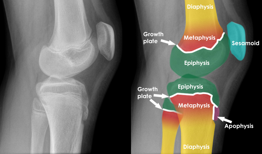 <p><strong><u>Definition:</u></strong></p><p>•Epiphyses are the <strong>rounded ends of bones</strong> that initially form separately from the main shaft of long bones and gradually fuse with it as a person ages.</p><p><strong><u>Growth Promotion:</u></strong></p><p>•Initially, <strong>low estrogen levels</strong> during the reawakening of the HPG axis promote <strong>linear bone growth</strong>, contributing to a <strong>rapid growth spurt</strong>.</p><p><strong><u>End of Growth</u></strong><u>:</u></p><p>As estrogen levels <strong>increase</strong>, they lead to <strong>epiphyseal fusion</strong>, signaling the <strong>cessation of linear growth</strong> and finalizing bone length.</p>