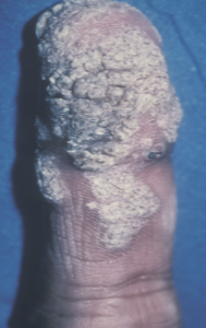 <p><strong>Human Papilloma Virus (HPV)</strong> causes <strong>warts</strong> on the skin, which can be raised, rough, or flat.</p><p>It is a <strong>viral infection</strong> that spreads through direct contact or contaminated surfaces.</p>