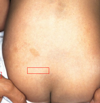 Large round or oval patch of lightbrown pigmentation. Usually normal finding.

