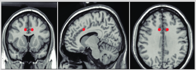 <p>Anterior cingulotomy involves creating a targeted lesion to disconnect the anterior cingulate cortex on both sides of the brain.</p><p>This procedure has been used for decades as a last resort treatment for patients with intractable pain.</p><p>It is typically considered when other treatments fail to manage severe, chronic pain.</p>