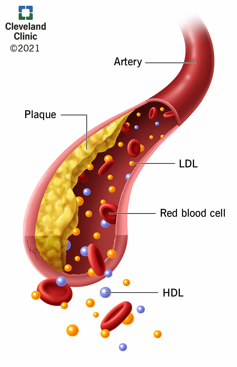 <p>-Deficiency in lipoprotein lipase or Apo C2 </p><p>-Characterised by high LDL </p><p>-Most are caused by a genetic defect in the synthesis, processing or function of the LDL receptor</p>