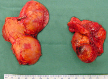 <p>The "Rule of 10" states that approximately 10% of phaeochromocytomas are bilateral, 10% are malignant, and 10% are extra-adrenal.</p>