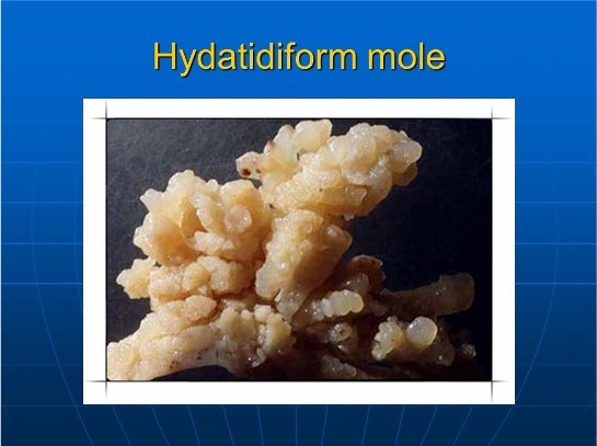 <p><strong>Type of gestational trophoblastic disease</strong></p><p>Benign proliferative growth of the placental trophoblast in which the chorionic villi develop into edematous, cystic, avascular transparent vesicles that hang in a grapelike cluster</p><p><strong>Types</strong></p><p>Complete: no embryonic or fetal parts</p><p>Partial: often have embryonic or fetal parts and an amniotic sac</p>