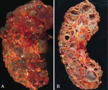 <p>A genetic condition where cysts develop and enlarge overtime in the kidneys. Manifestations occur in adulthood and develops into chronic renal failure.</p>