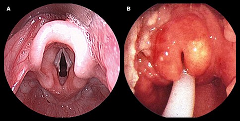 <p>•The epiglottis — a small cartilage "lid" that covers the trachea — wells.  Epiglottitis can be deadly</p><p>•Severe sore throat</p><p>•Difficulty swallowing</p><p>•Stridor</p><p><strong><u><span class="tt-bg-red">•DO NOT</span></u></strong></p><p>•Attempt to visualize the throat - laryngospasm</p><p>•Leave the child unattended</p><p>•Place the child in a supine position</p><p><strong><u><span class="tt-bg-green">•DO</span></u></strong></p><p>•Provide 100% oxygen in the least invasive manner</p><p>•Ensure tracheostomy tray and emergency equipment readily&nbsp; available</p>