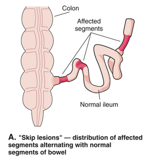 <p>Skip lesions - lesions with normal tissue separating each one.</p>