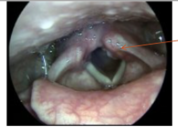 <p>Perceptual: low pitch (may be glottal fry), persistent hard glottal attacks. Patient may complain of pain in the larynx, vocal fatigue or referred pain to neck or ear.Acoustic: not enough data</p>