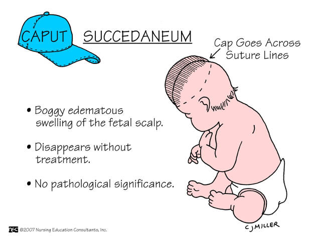 <p>Boggy edematous swelling of fetal scalp(disappears w/o treatment)</p><p>No pathological treatment</p><p>soft-pits</p><p>Crosses the suture line (fluid/edema)</p>