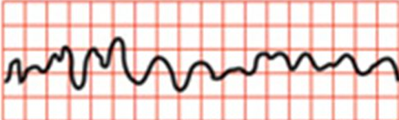 <p>a) premature atrial contraction (PAC)</p><p>b) atrial flutter</p><p>c) atrial fibrillation</p><p>d) torsades de pointes</p><p>e) ventricular fibrillation</p>