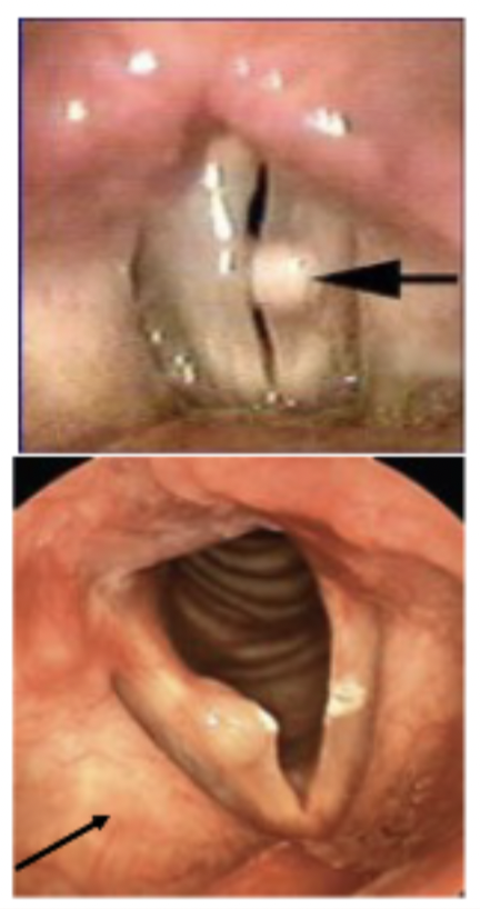 <p>• Vocal Fold Cysts: o Small spheres on the margins of the vocal folds or on superior surface of the fold. Cysts are often unilateral and frequently mistaken for early nodules or polyps.o Etiology: May be caused by the blockage of a glandular duct , causing a retention of mucosa possibly combined with phonotrauma or may be congenital.</p>