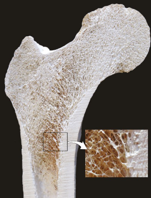 <p>Cancellous bone is <strong>lighter</strong>, <strong>weaker</strong>, and more <strong>flexible</strong> than cortical bone.</p><p>It is arranged in <strong>trabeculae</strong>, which are structures that align with the direction of stress when mature.</p><p>It has a <strong>higher surface area to volume ratio</strong>, making it more suitable for <strong>metabolic activity</strong>.</p><p>The spaces between the trabeculae are filled with <strong>bone marrow</strong>, which can be either red or yellow.</p>