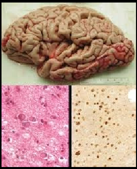 <p><strong>Primary tauopathy (FTD-Tau)</strong>: A neurodegenerative condition, particularly <strong>frontotemporal dementia (FTD)</strong> associated with tau protein abnormalities.</p>