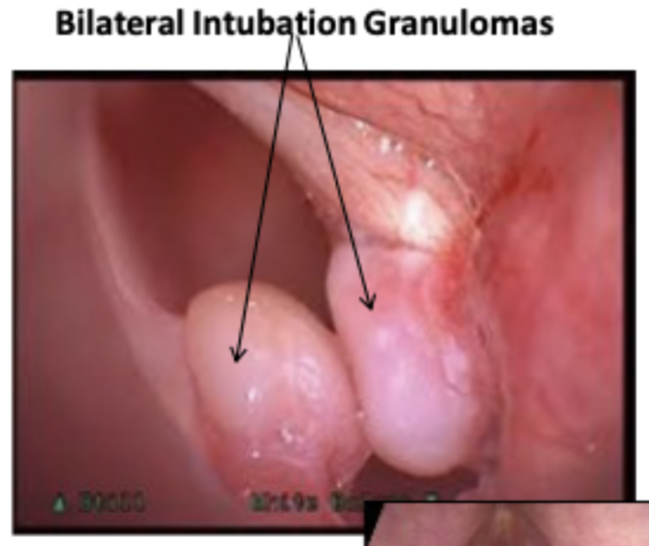 <p>Laryngeal granuloma: Trauma to the vocal fold or vocal process due to contact with the intubation tube causing granulation tissue to form.</p><p>Etiology:• Complication of intubation dependent on:o duration of intubation, o method of intubation,o patient’s ageo Patient’s general health condition.• LPR/GERD</p>