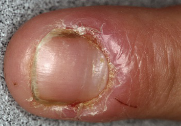 Red, swollen, tender inflammation of the nail folds.
Acute paronychia is usually a bacterial infection with
pus in the proximal nail fold, pain, and throbbing.
Chronic paronychia is most often a fungal infection
from a break in the cuticle in those who perform “wet”
work
