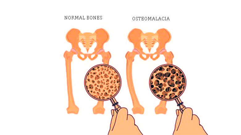 <p>Vitamin D deficiency (most common)</p><p>Vitamin D metabolism defects (rare)</p><p>Phosphate wasting (rare)</p>