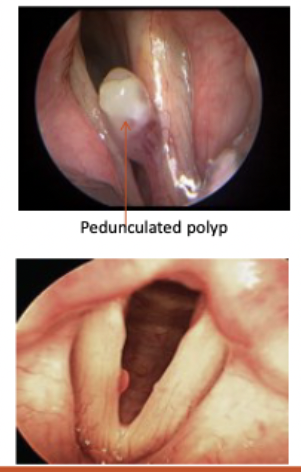 <p>◦Characteristics: ◦Perceptual: ◦Hoarseness, roughness or breathiness. ◦Patient may report sensation of something in the throat.◦ NOTE: Typically, dysphonia is worse for patients with polyps compared to nodules.◦Acoustic:◦Increased jitter and shimmer depending on the site of the lesion◦Reduced phonation range.</p>