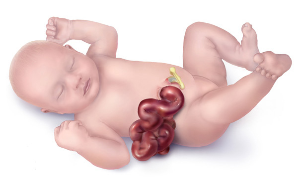 <p>Gastroschisis is a condition characterized by the failure of the ventral body wall to fuse, resulting in exposed intestines without covering.</p>