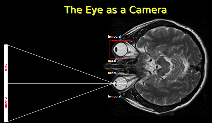 <p><strong>Temporal retina:</strong> Located on the side closer to the temples.</p><p><strong>Nasal retina:</strong> Located on the side closer to the nose.</p><p><strong>Temporal-nasal orientation:</strong> Refers to the arrangement of visual field regions.</p><p><strong>Example:</strong> Light from the right visual field falls on the nasal retina of the right eye and temporal retina of the left eye.</p>