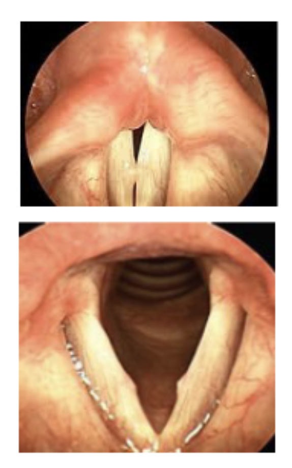 <p>-benign growths on the vocal folds, usually in the anterior 1/3.◦Etiology: usually caused by vocal abuse. A reaction of the tissue to constant stress induced by frequent, hard oppositional movement of the vocal folds.◦Early nodules- often soft /pliable, may be unilateral or bilateral◦Chronic nodules- often hard, white, thick, usually bilateral</p>