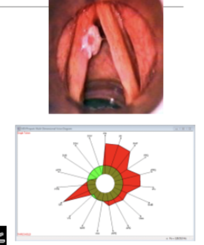 <p>Etiology: (any combination of the following)◦ Smoking,◦ Alcohol abuse,◦ Environmental pollutants,◦ Vocal hyperfunction, ◦ Prolonged laryngitis.</p><p>Keratosis Characteristics:◦ Perceptual –hoarseness, rough vocal quality◦ Acoustic –no known data at this time.</p>