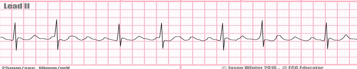 <p>a) premature atrial contraction (PAC)</p><p>b) atrial flutter</p><p>c) atrial fibrillation</p><p>d) torsades de pointes</p><p>e) ventricular fibrillation</p>