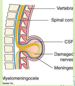 <p>Herniation of spinal cord and nerves along with meninges and CSF.</p>