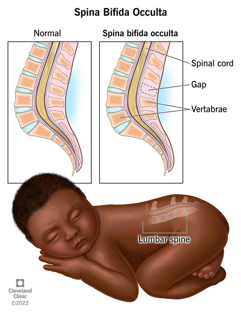 <p>-defect of vertebral bodies without protrusion of spinal cord or meninges</p><p>-not visible externally and in most cases no adverse effects</p><p>-need no immediate medical intervention</p><p>-complications are rare, abnormalities of spinal cord</p><p>-<strong><em><u><span class="tt-bg-red">dimpling or tats of hair in lumbosacral area- MRI</span></u></em></strong></p>